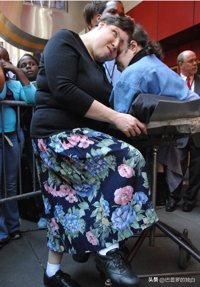 世界最长寿连体女婴去世，一生从未见面，却相伴生活62年