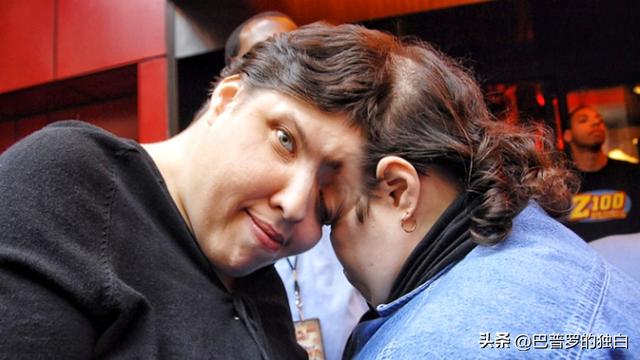 世界最长寿连体女婴去世，一生从未见面，却相伴生活62年