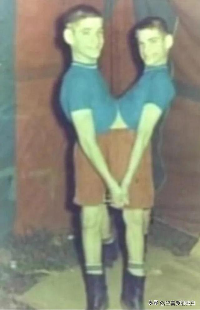 世界最长寿连体女婴去世，一生从未见面，却相伴生活62年